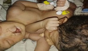 Tragic loss to family in Ambala: Conjoined twin girls share heart, succumb within 48 hours