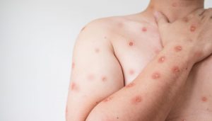 Himachal Govt prepares for monkey pox, health secretary chairs special meeting