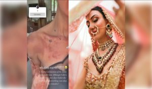 Priyanka Chopra’s bhabhi Neelam Upadhyaya suffers burns on her skin