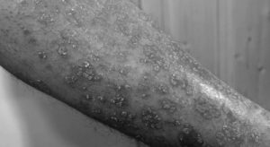Skin cancer surges worldwide in older men in last 30 years