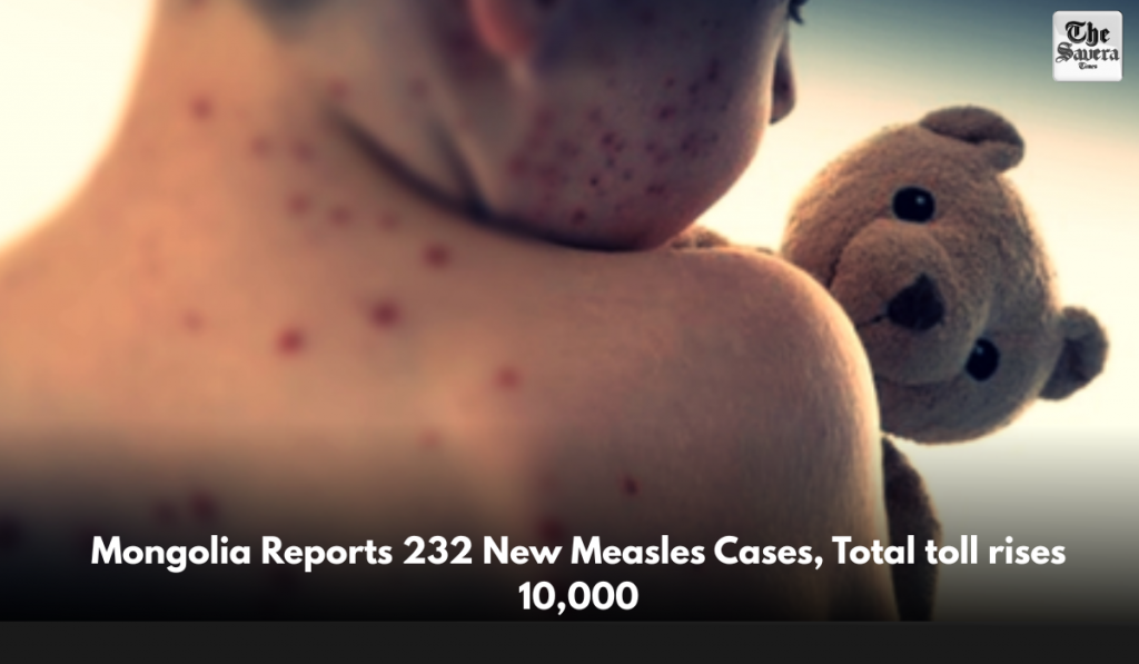 Mongolia Reports 232 New Measles Cases, Total toll exceeds 10,000