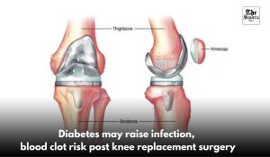 Diabetes may raise infection, blood clot risk post knee replacement surgery