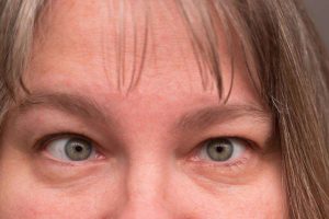 How ‘Lazy Eye’ Poses Risk