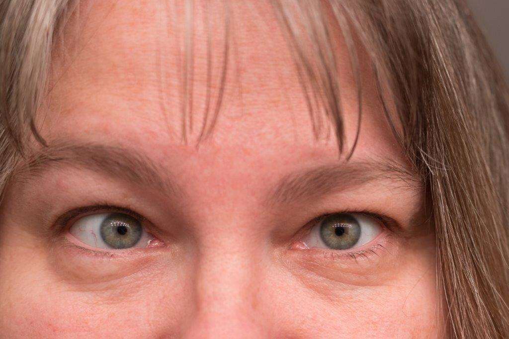 How ‘Lazy Eye’ Poses Risk