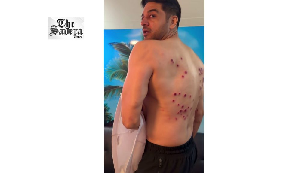 Gaurav Khanna Shows Painful Laser Burn Marks After Khatron Ke Khiladi 15 Task