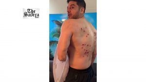 Gaurav Khanna Shows Painful Laser Burn Marks After Gruelling ‘Khatron Ke Khiladi 15’ Task