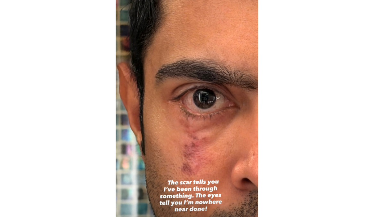 Abhishek Banerjee Shares ‘Scar’ Photo Amid Ongoing Eye Treatment in US